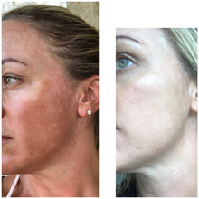 Load image into Gallery viewer, Melasma Soap