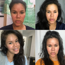 Load image into Gallery viewer, Acne Dark Spot Kit