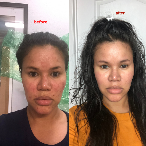 How To Get Rid Of Dark Spots From Acne (For Medium To Dark Skin Tone)