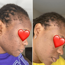 Load image into Gallery viewer, kojic acid serum sensitive skin before and after photos
