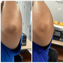 Load image into Gallery viewer, kojic acid soap before and after photos pictures black skin elbows review
