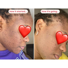 Load image into Gallery viewer, kojic acid soap before and after photos black skin review face
