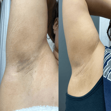 Load image into Gallery viewer, kojic acid soap before and after underarms pictures review
