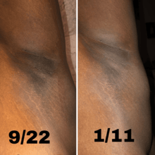 Load image into Gallery viewer, kojic acid soap before and after underarms pictures review reddit
