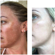 Load image into Gallery viewer, Natural Melasma Set - Marie France Skin &amp; Body Care
